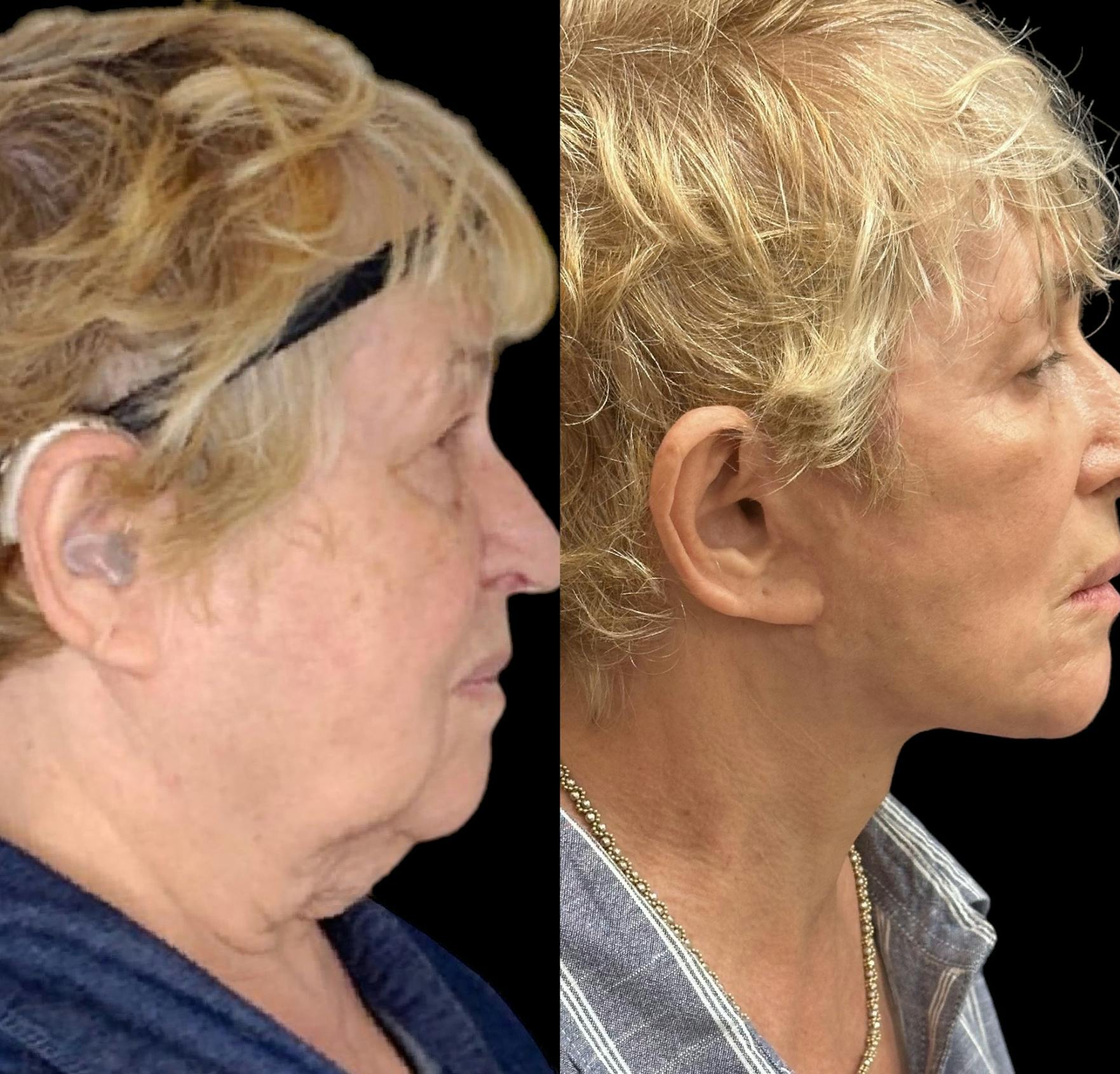 Neck Lift