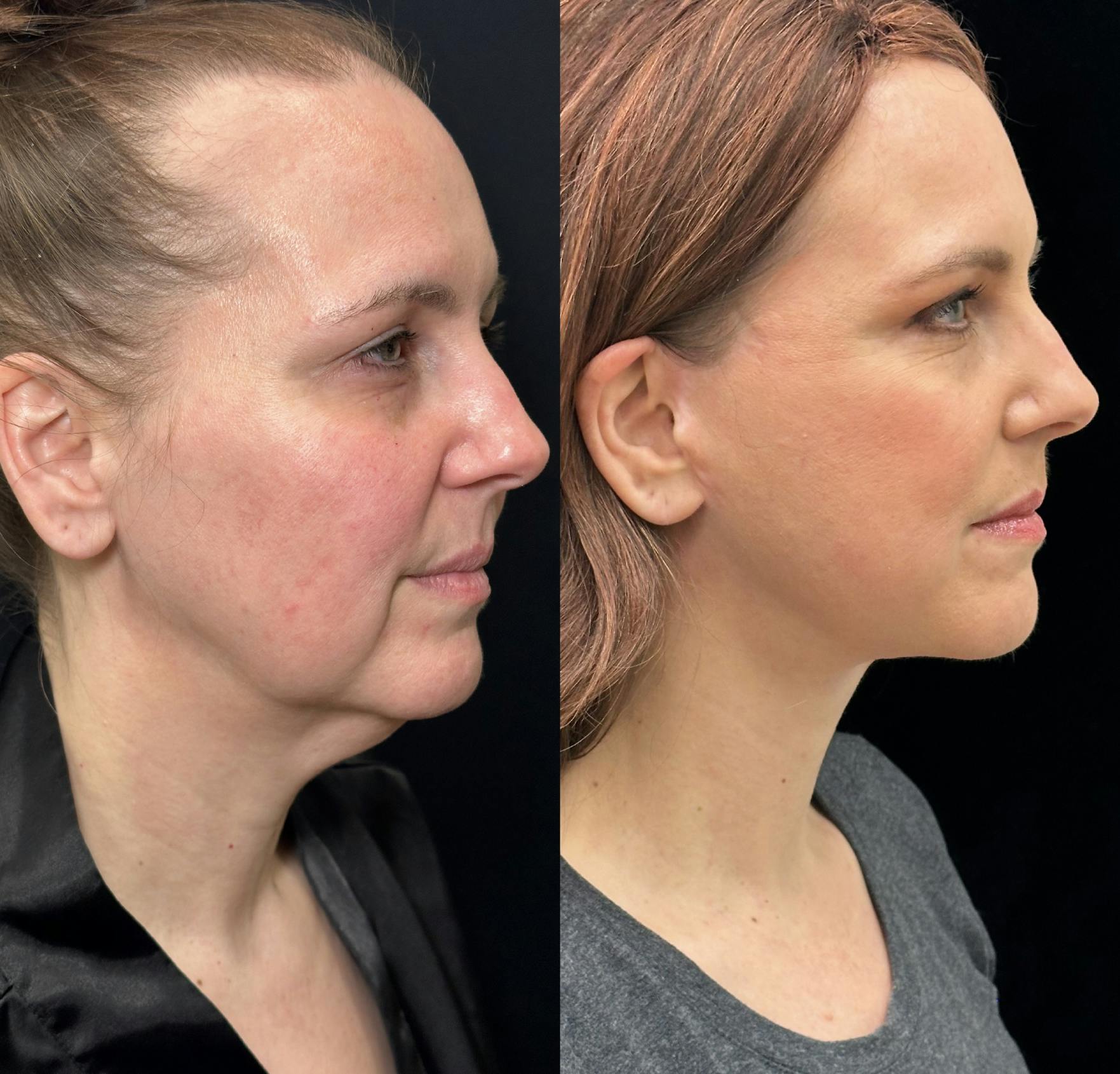 Facelift
