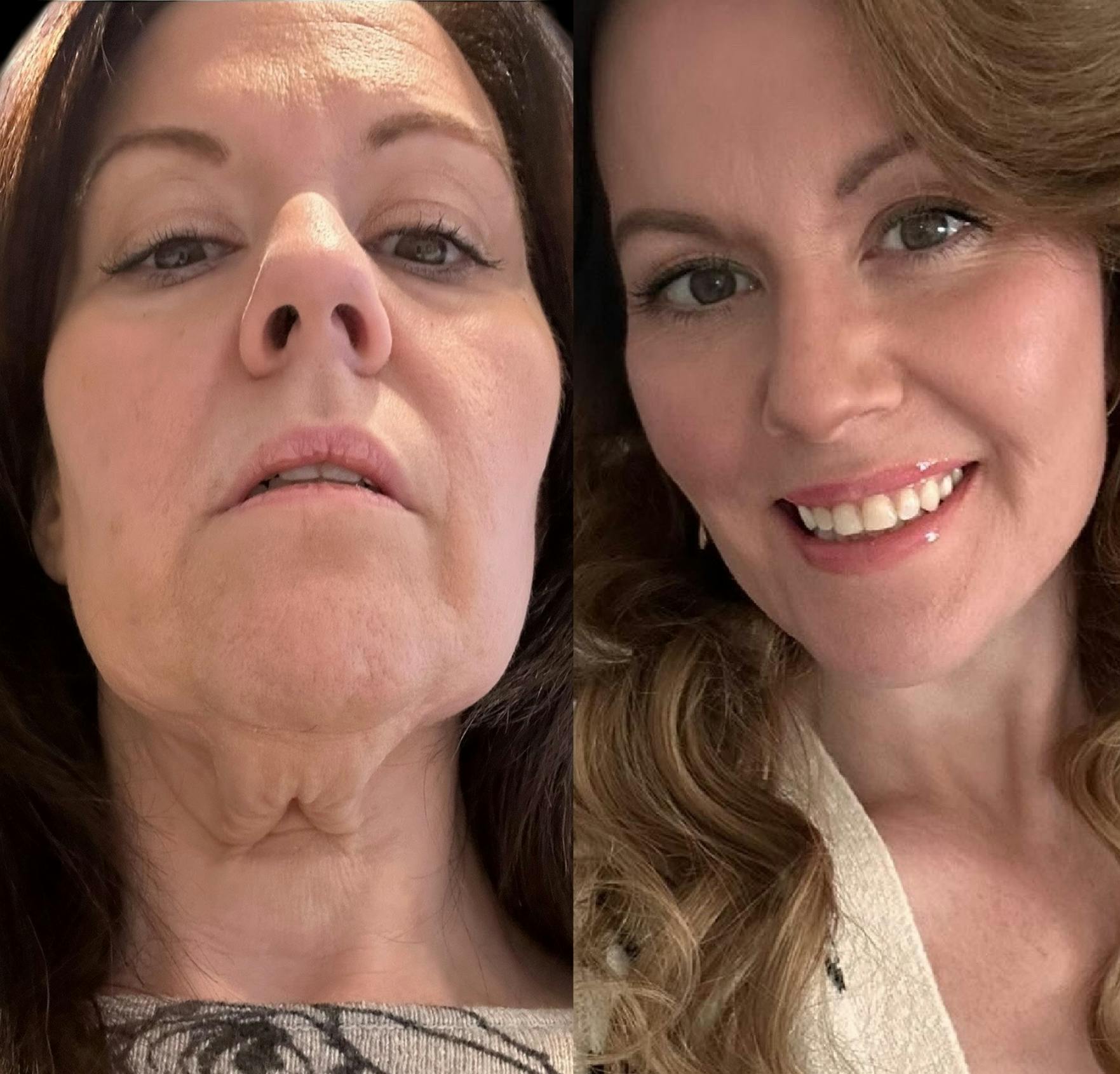 Facelift