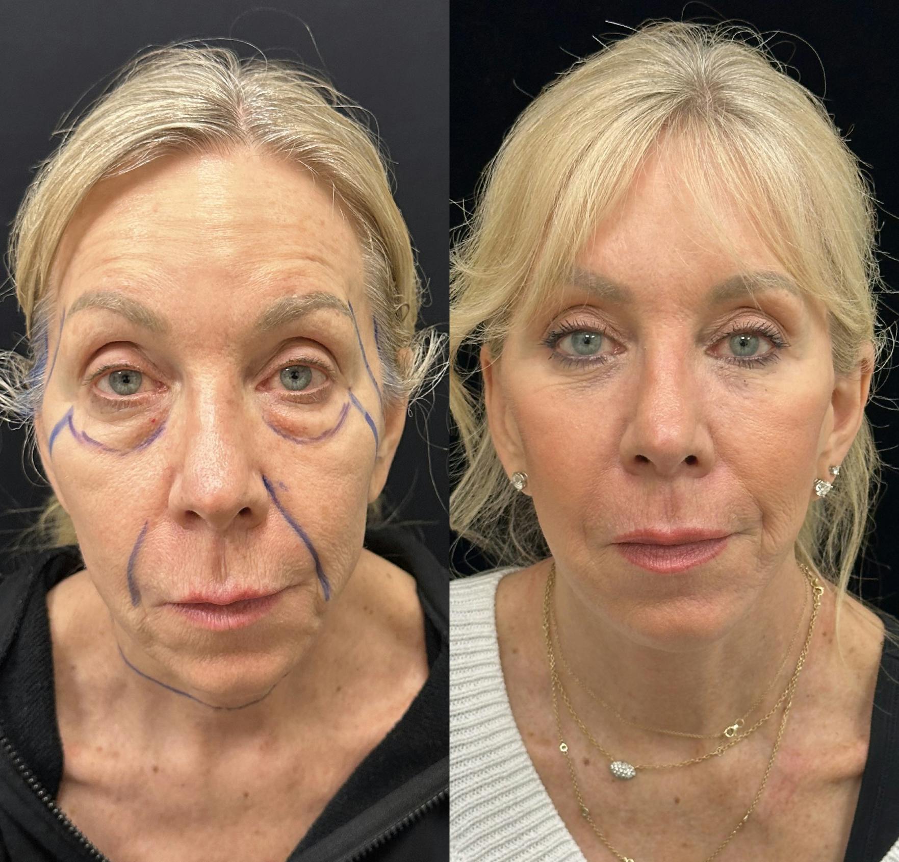Facelift