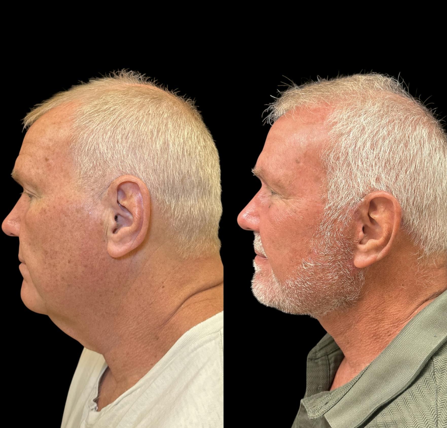Facelift