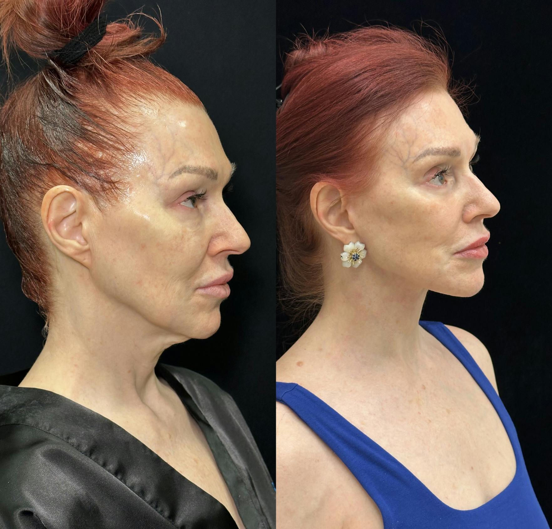 Facelift