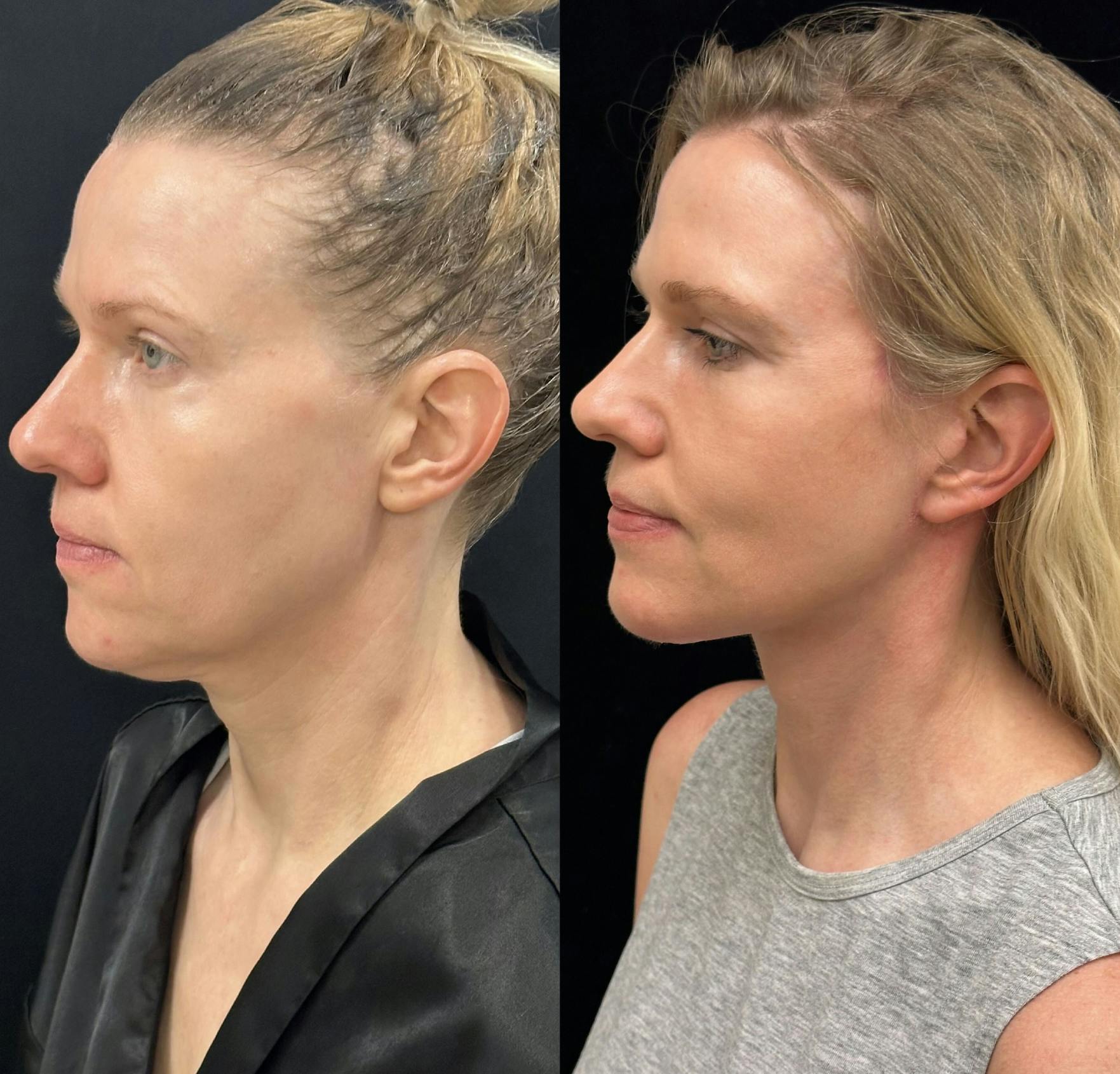 Facelift