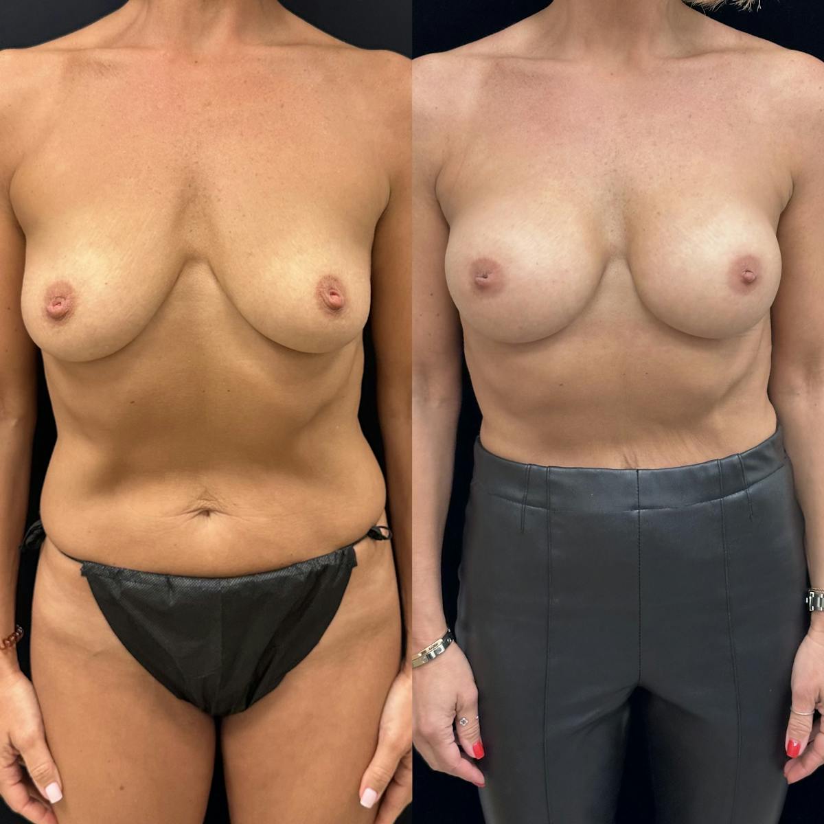  Breast Augmentation Before & After Gallery - Patient 144695 - Image 1