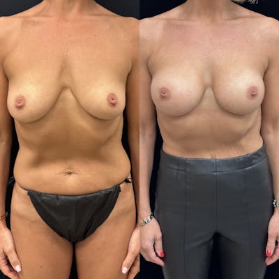 Breast Augmentation Before & After Gallery - Patient 144695 - Image 1