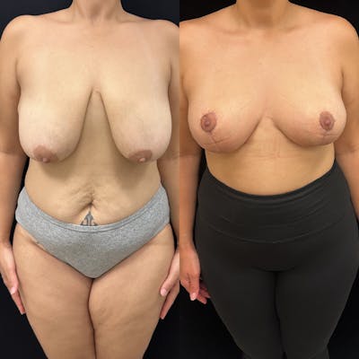 Breast Lift Before & After Gallery - Patient 220745 - Image 1