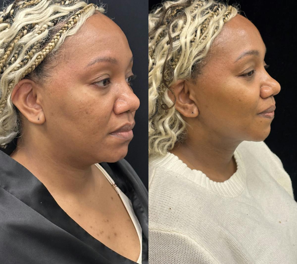 Chin & Neck Lipo Sculpting Before & After Gallery - Patient 232114 - Image 2