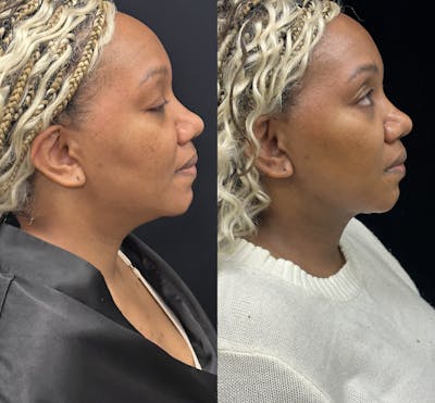 Chin & Neck Lipo Sculpting Before & After Gallery - Patient 232114 - Image 4