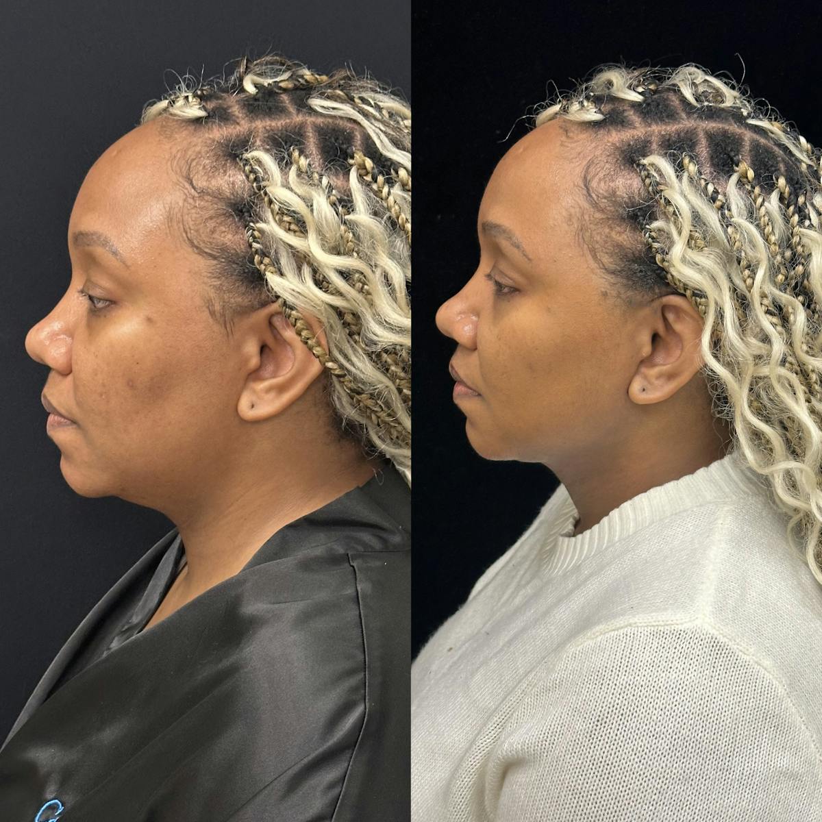 Chin & Neck Lipo Sculpting Before & After Gallery - Patient 232114 - Image 5