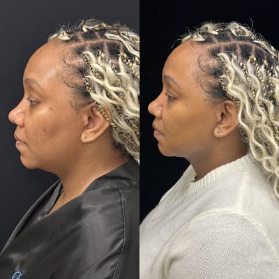 Chin & Neck Lipo Sculpting Before & After Gallery - Patient 232114 - Image 5