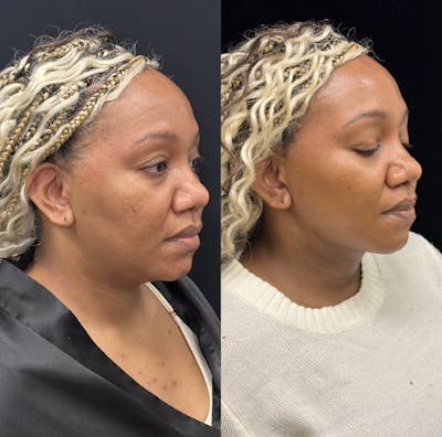 Chin & Neck Lipo Sculpting Before & After Gallery - Patient 232114 - Image 1