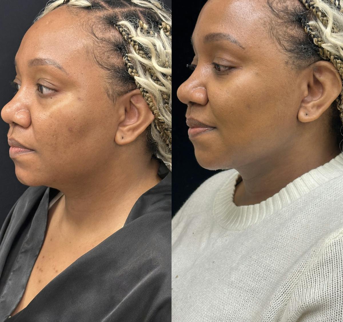 Chin & Neck Lipo Sculpting Before & After Gallery - Patient 232114 - Image 3