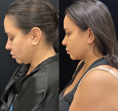 Chin & Neck Lipo Sculpting Before & After Gallery - Patient 168965 - Image 3