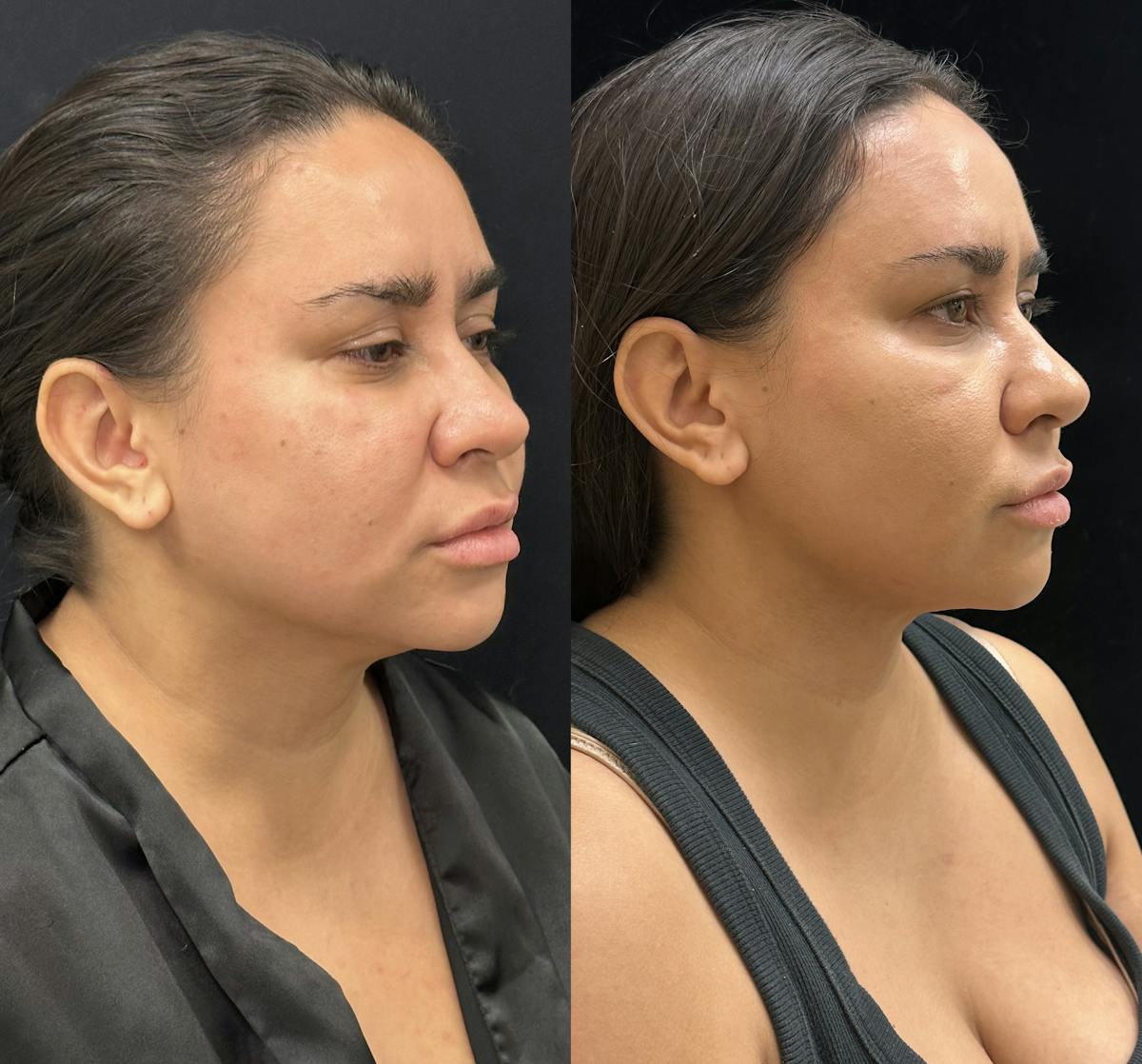 Chin & Neck Lipo Sculpting Before & After Gallery - Patient 168965 - Image 2