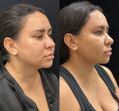Chin & Neck Lipo Sculpting Before & After Gallery - Patient 168965 - Image 2