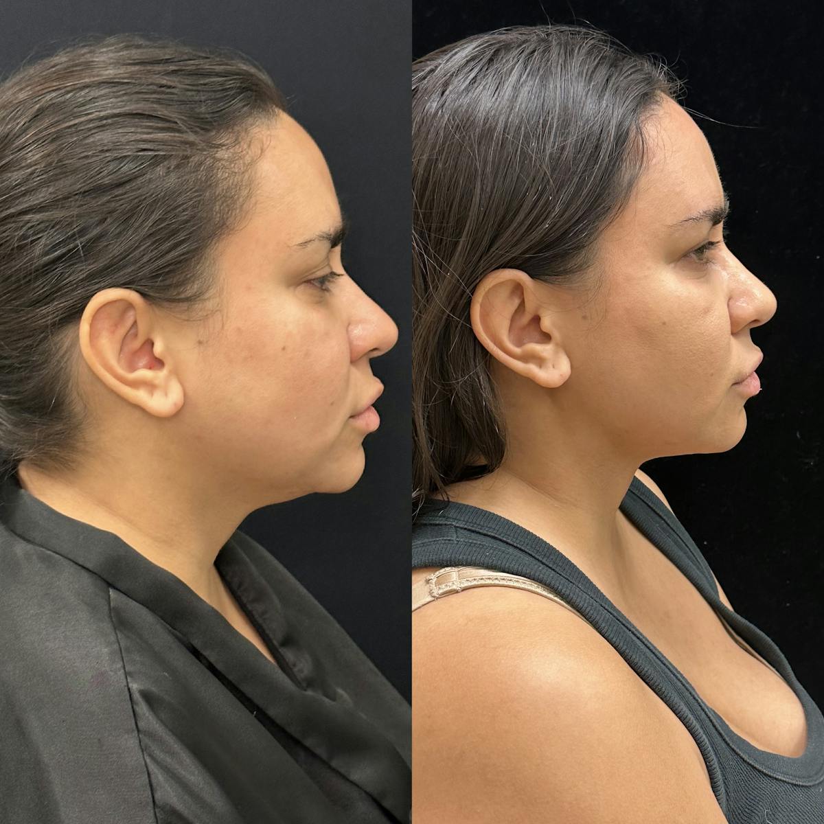 Chin & Neck Lipo Sculpting Before & After Gallery - Patient 168965 - Image 1