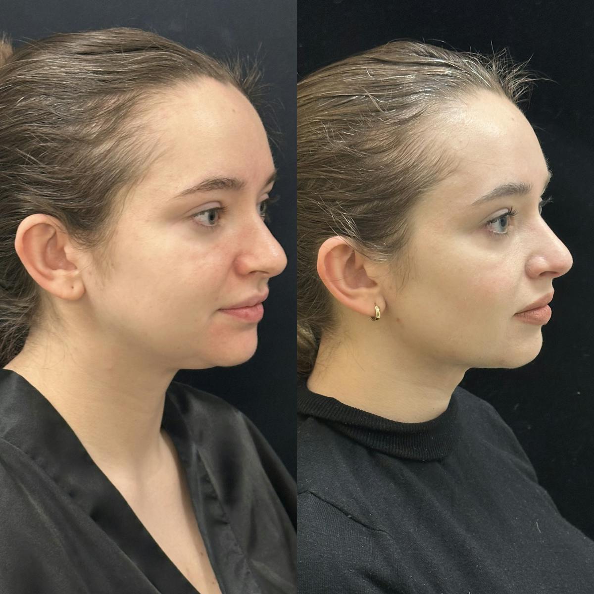 Chin & Neck Lipo Sculpting Before & After Gallery - Patient 344368 - Image 2