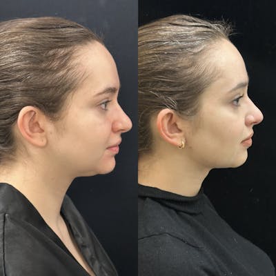 Chin & Neck Lipo Sculpting Before & After Gallery - Patient 344368 - Image 1