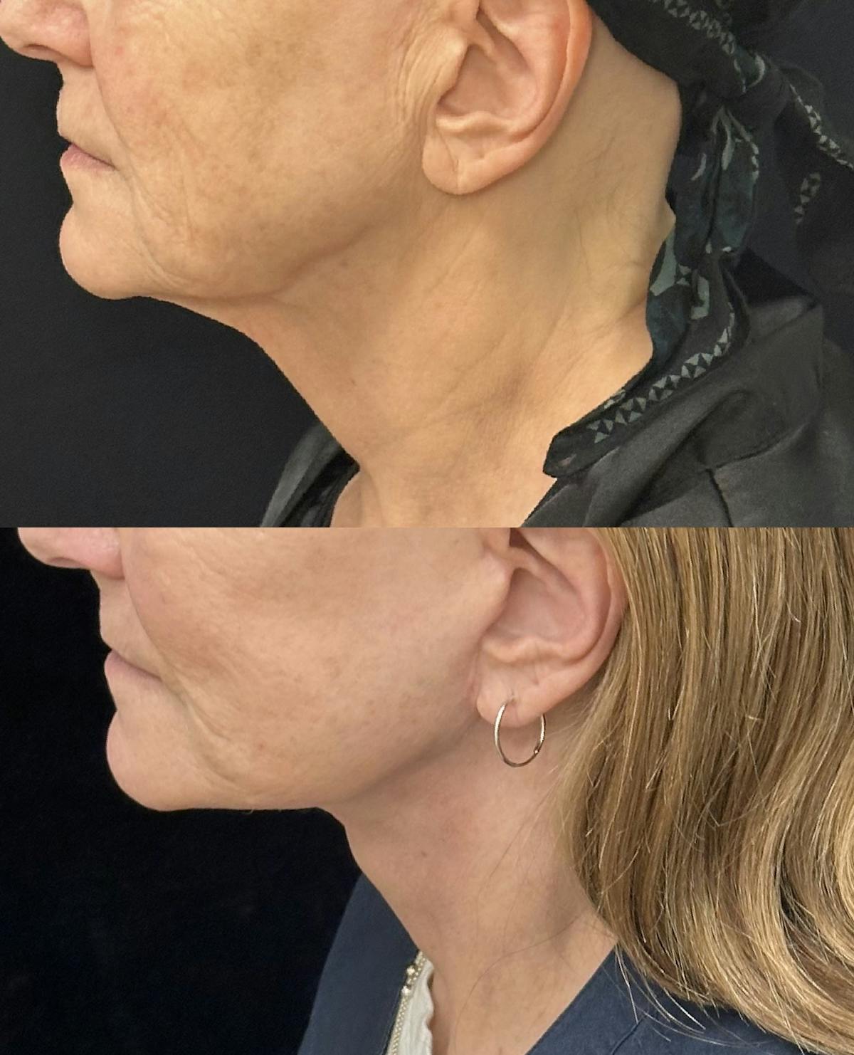 Deep Plane Facelift Before & After Gallery - Patient 394772 - Image 1