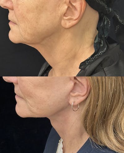 Deep Plane Facelift Before & After Gallery - Patient 394772 - Image 1