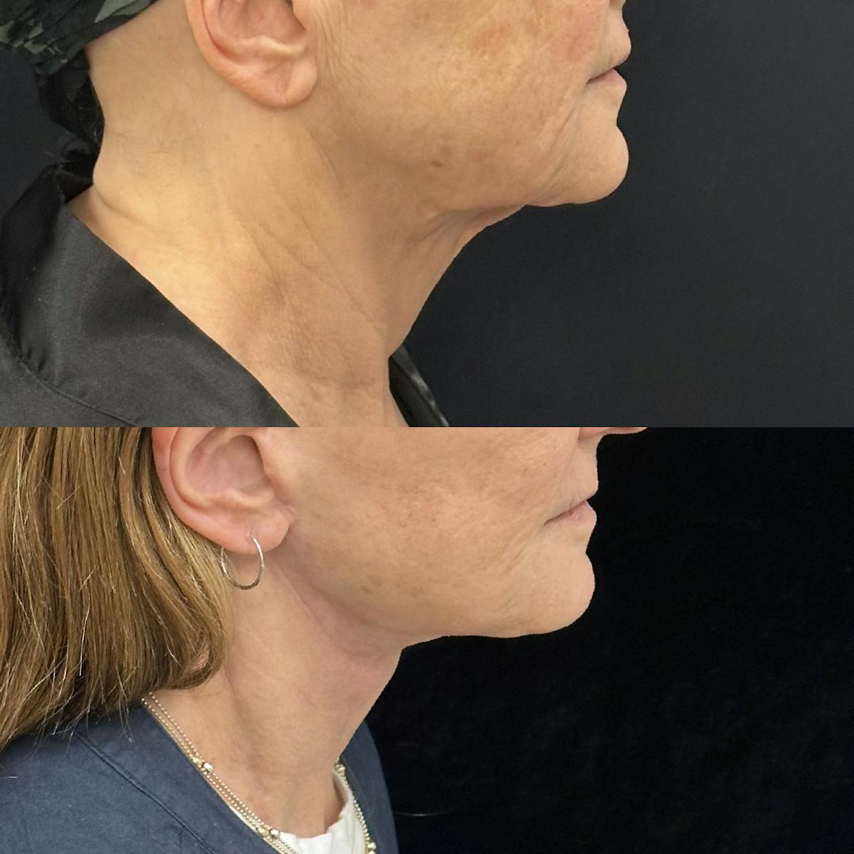 Deep Plane Facelift Before & After Gallery - Patient 394772 - Image 4