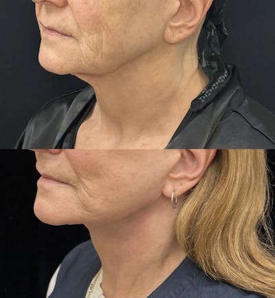 Deep Plane Facelift Before & After Gallery - Patient 394772 - Image 2