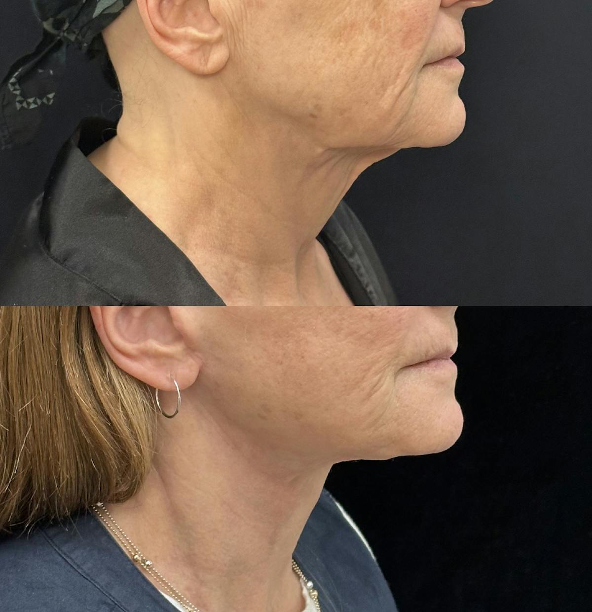 Deep Plane Facelift Before & After Gallery - Patient 394772 - Image 3