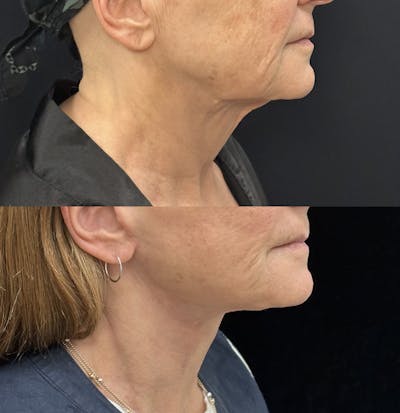 Deep Plane Facelift Before & After Gallery - Patient 394772 - Image 3