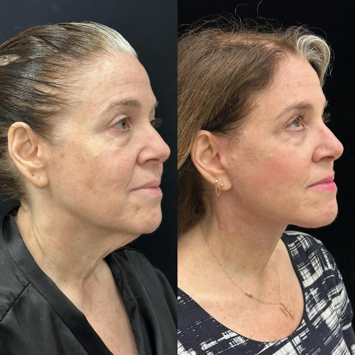 Deep Plane Facelift Before & After Gallery - Patient 355785 - Image 4
