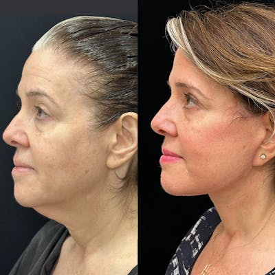 Deep Plane Facelift Before & After Gallery - Patient 355785 - Image 3