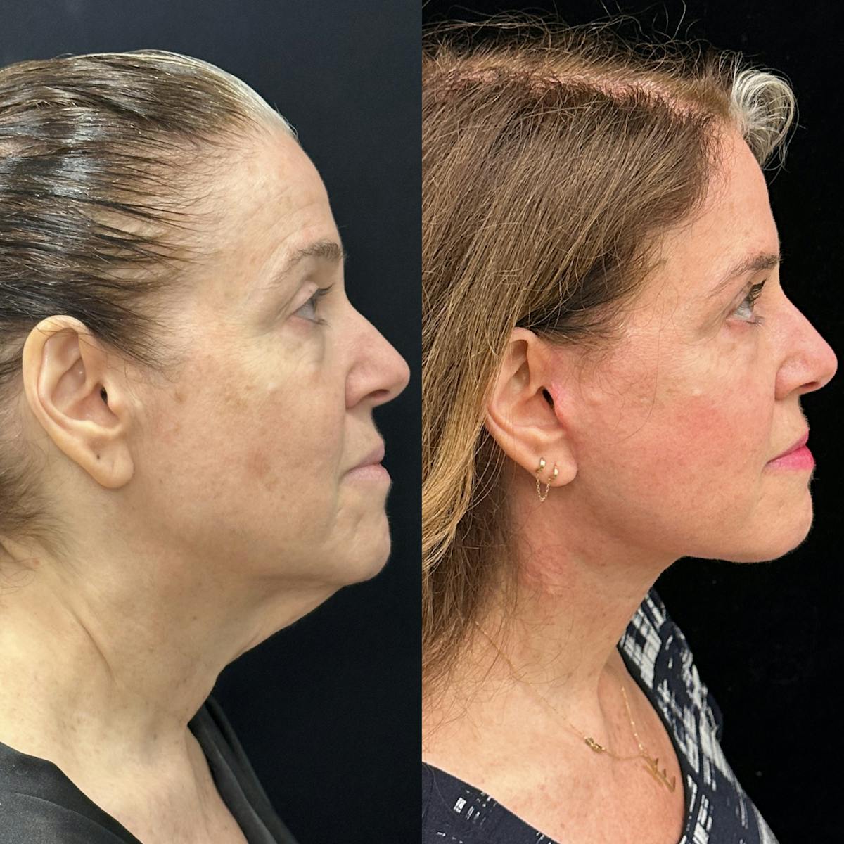 Deep Plane Facelift Before & After Gallery - Patient 355785 - Image 5