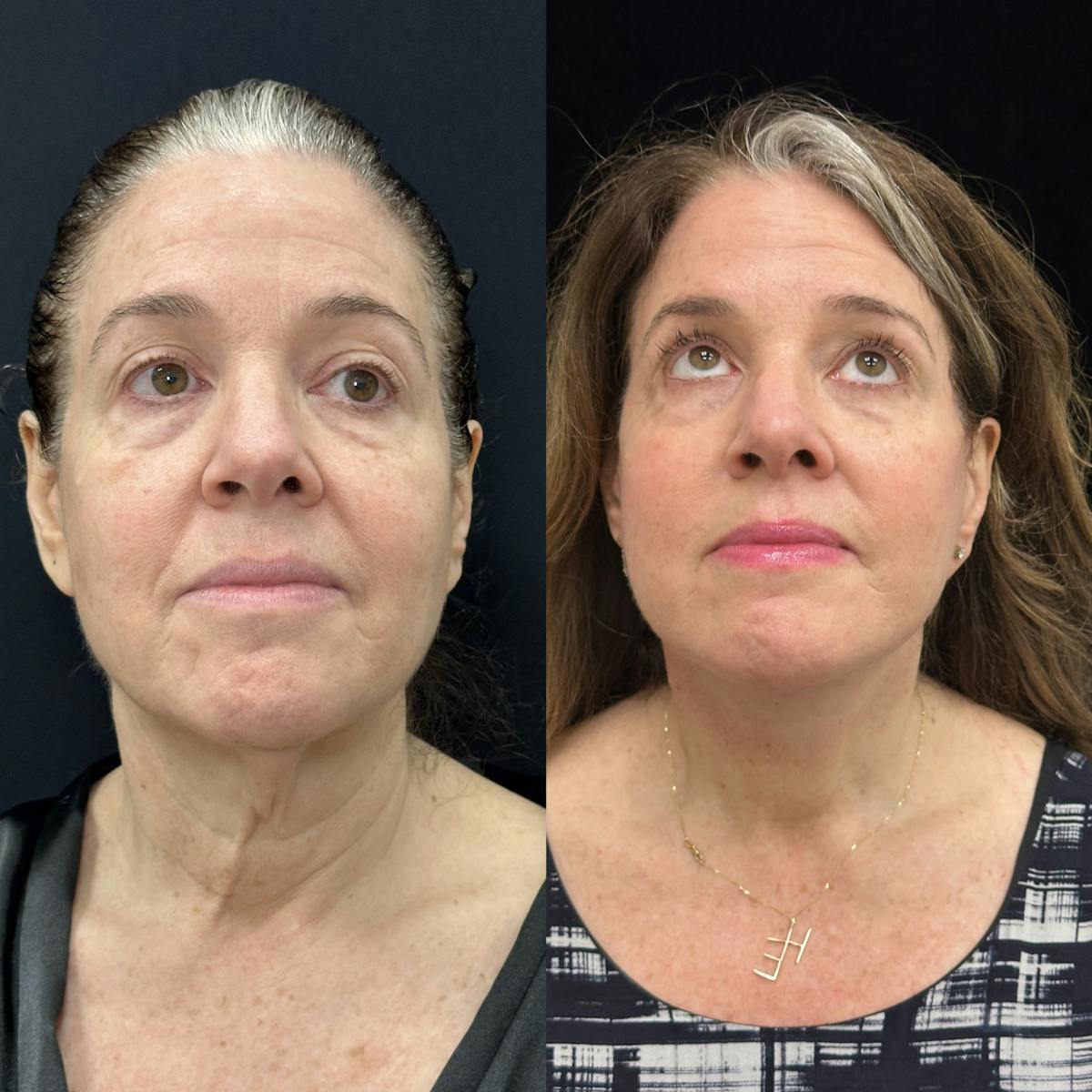 Deep Plane Facelift Before & After Gallery - Patient 355785 - Image 1