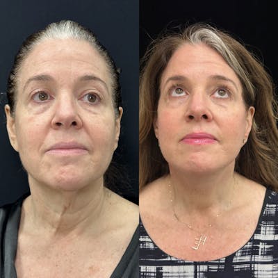 Deep Plane Facelift Before & After Gallery - Patient 355785 - Image 1