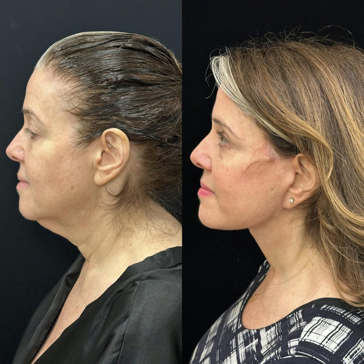 Deep Plane Facelift Before & After Gallery - Patient 355785 - Image 2