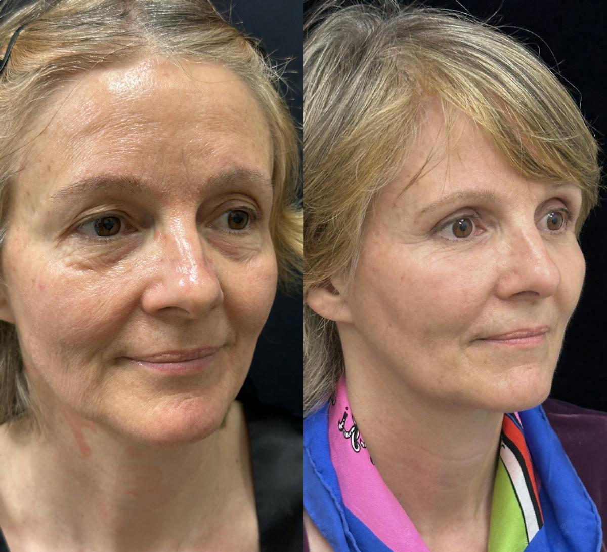 CO2 Laser Face Resurfacing Before & After Gallery - Patient 170766 - Image 2