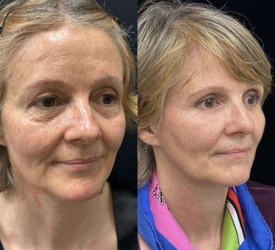 CO2 Laser Face Resurfacing Before & After Gallery - Patient 170766 - Image 2