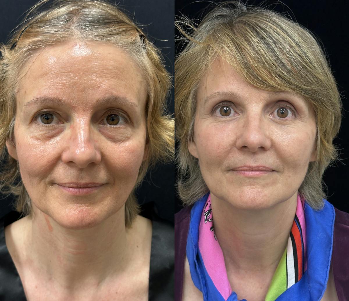 CO2 Laser Face Resurfacing Before & After Gallery - Patient 170766 - Image 1