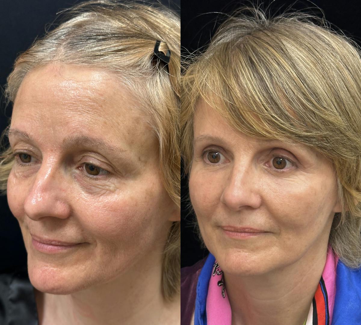 CO2 Laser Face Resurfacing Before & After Gallery - Patient 170766 - Image 3