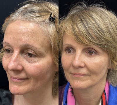 CO2 Laser Face Resurfacing Before & After Gallery - Patient 170766 - Image 3