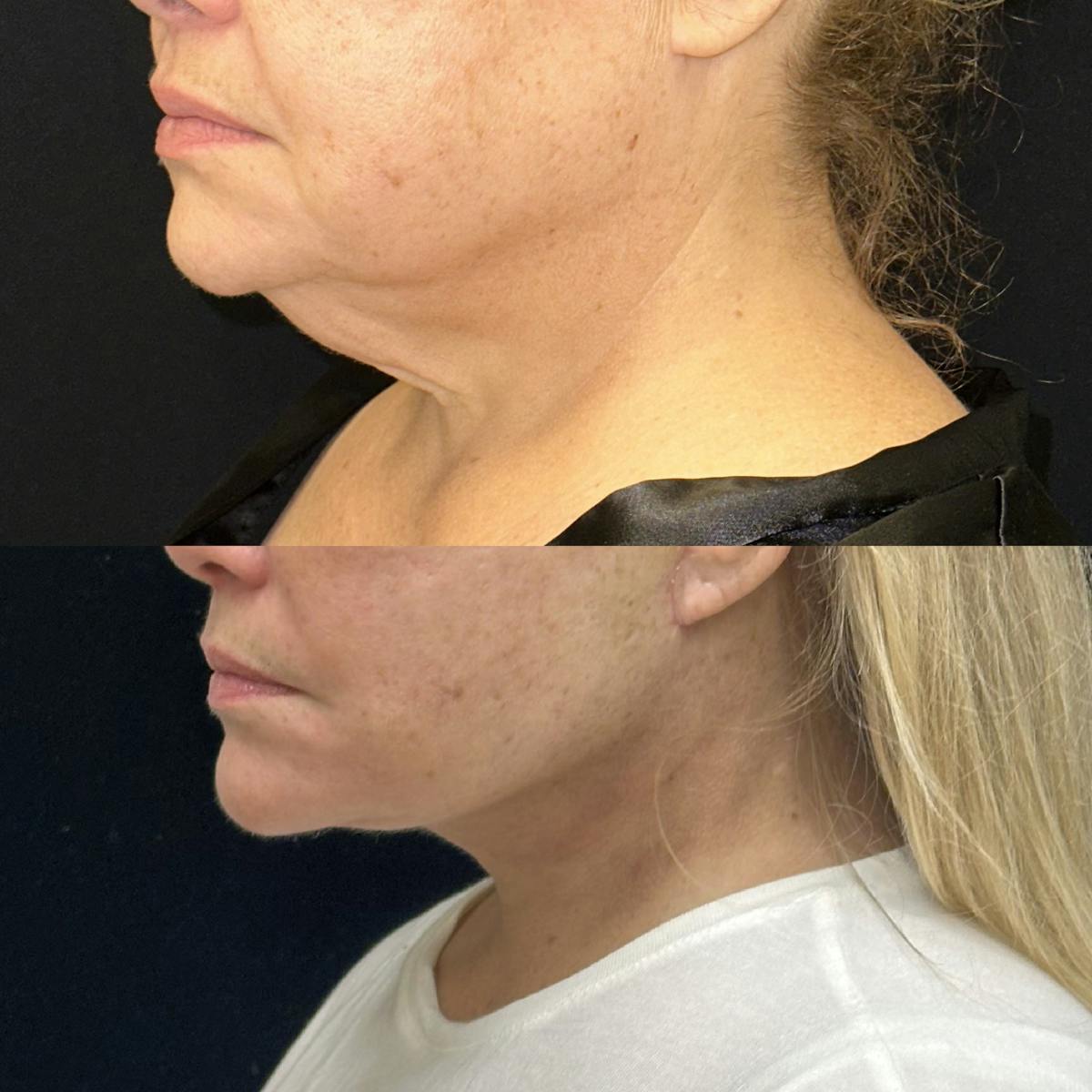 Deep Plane Facelift Before & After Gallery - Patient 209028 - Image 4