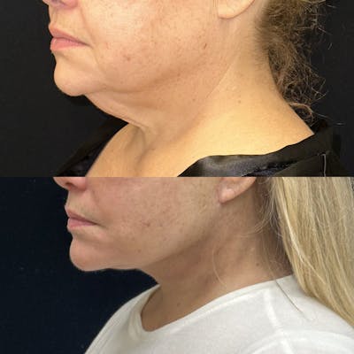 Deep Plane Facelift Before & After Gallery - Patient 209028 - Image 4