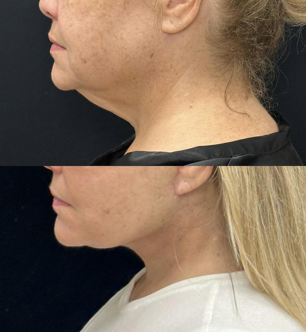 Deep Plane Facelift Before & After Gallery - Patient 209028 - Image 3