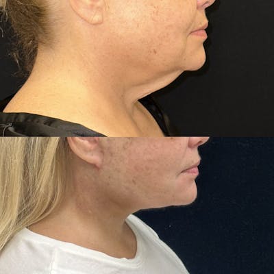 Deep Plane Facelift Before & After Gallery - Patient 209028 - Image 2