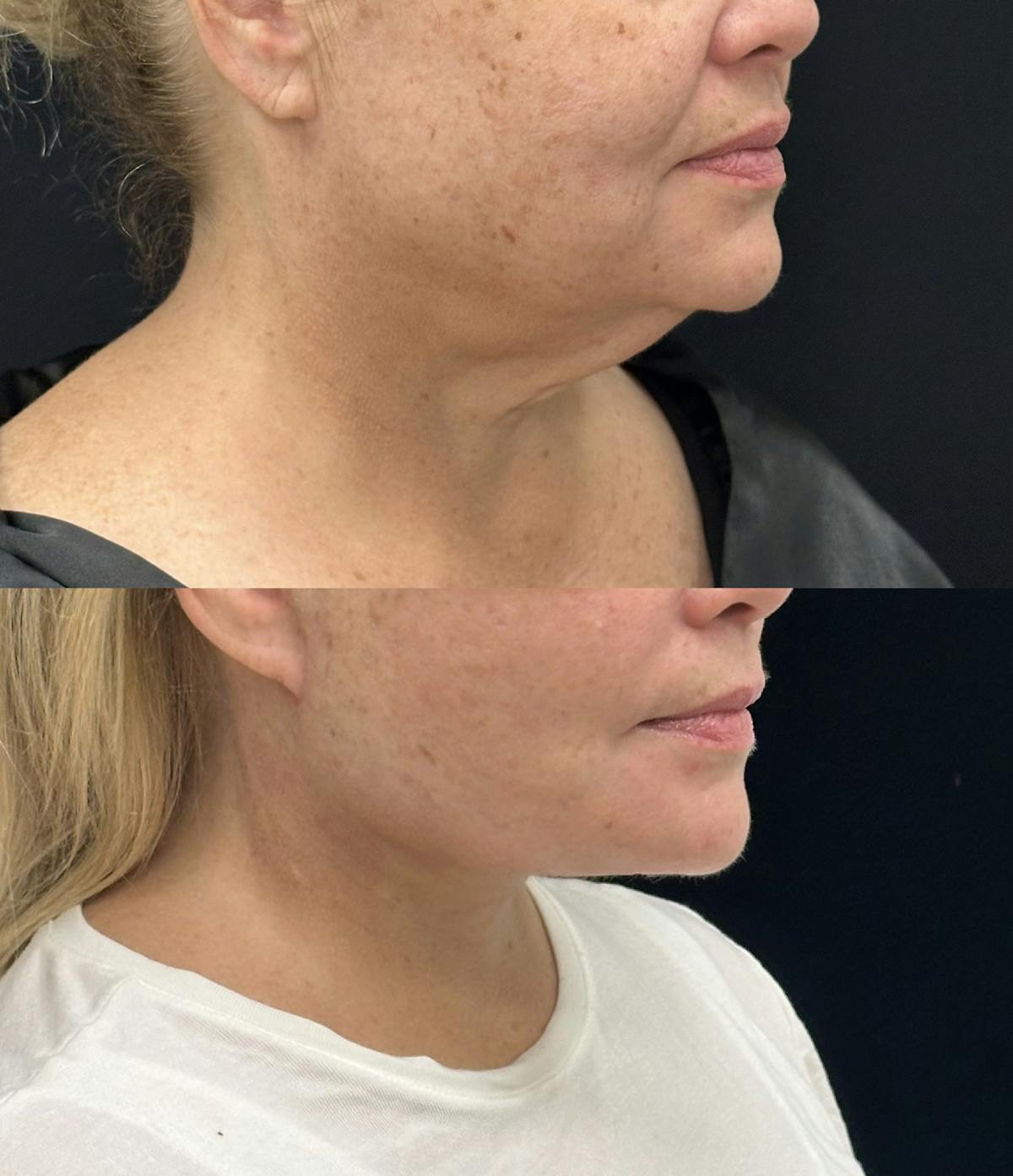 Deep Plane Facelift Before & After Gallery - Patient 209028 - Image 1