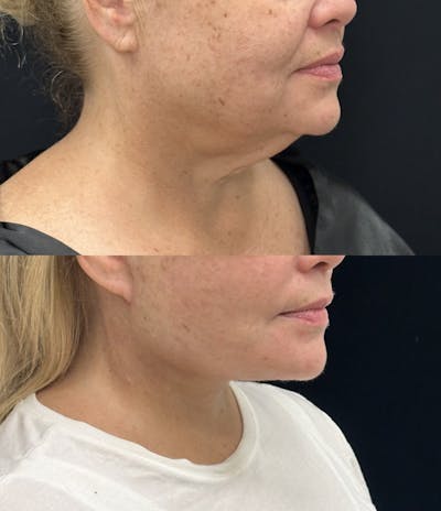 Deep Plane Facelift Before & After Gallery - Patient 209028 - Image 1
