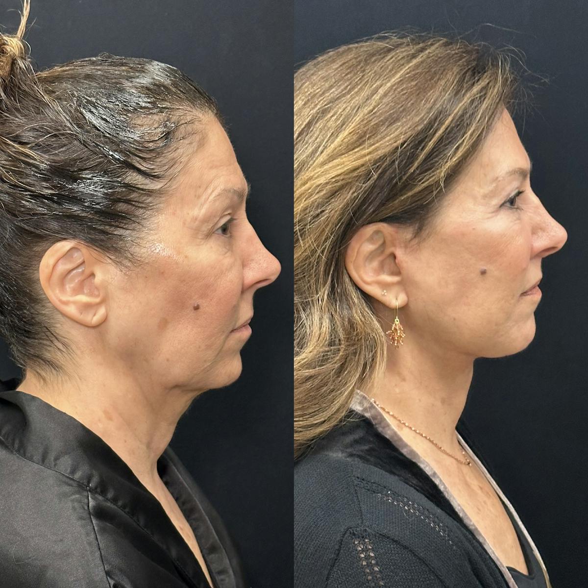 Deep Plane Facelift Before & After Gallery - Patient 931041 - Image 1