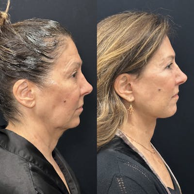 Deep Plane Facelift Before & After Gallery - Patient 931041 - Image 1