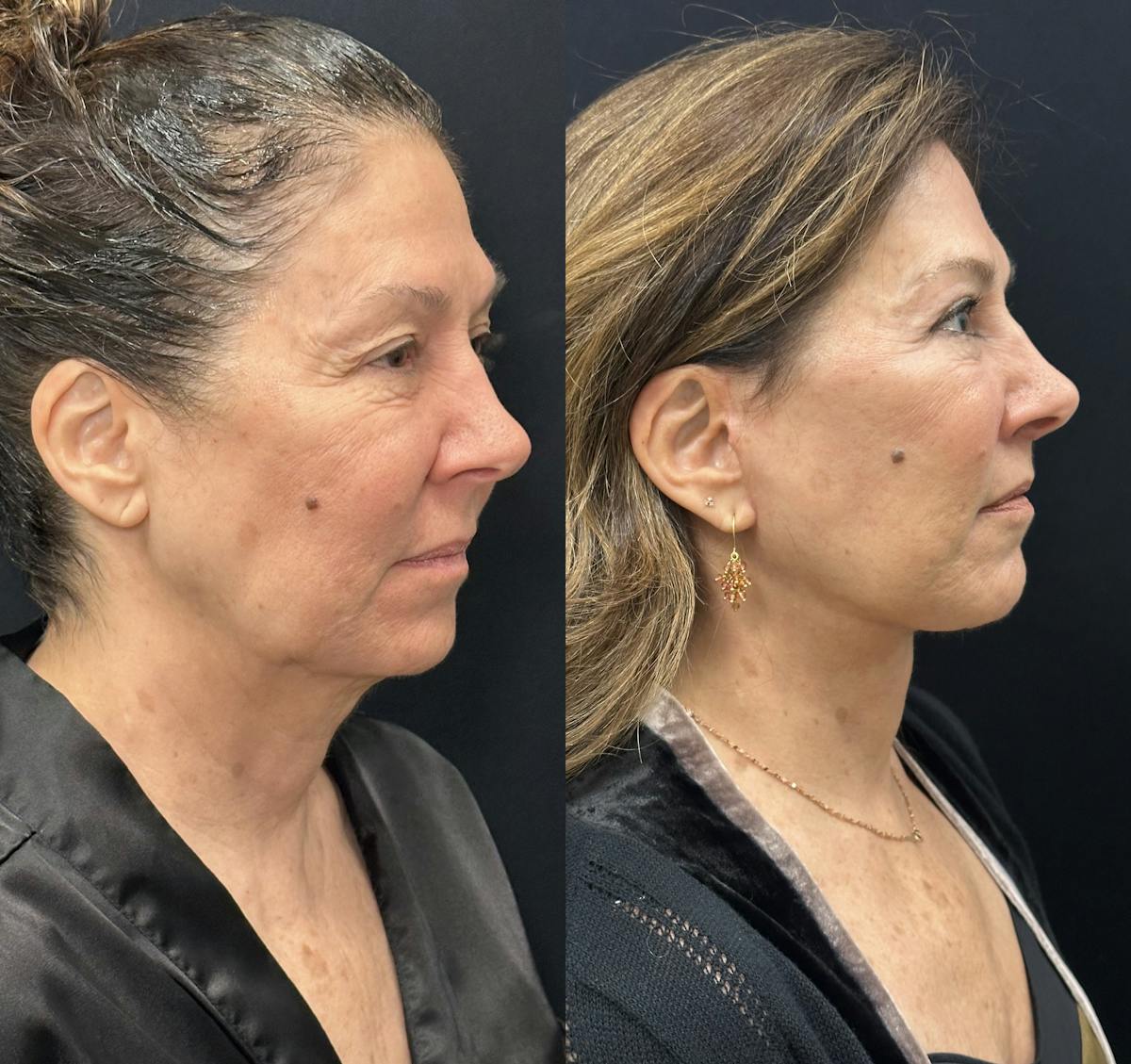 Deep Plane Facelift Before & After Gallery - Patient 931041 - Image 2