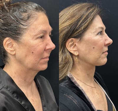 Deep Plane Facelift Before & After Gallery - Patient 931041 - Image 2