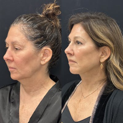 Deep Plane Facelift Before & After Gallery - Patient 931041 - Image 4